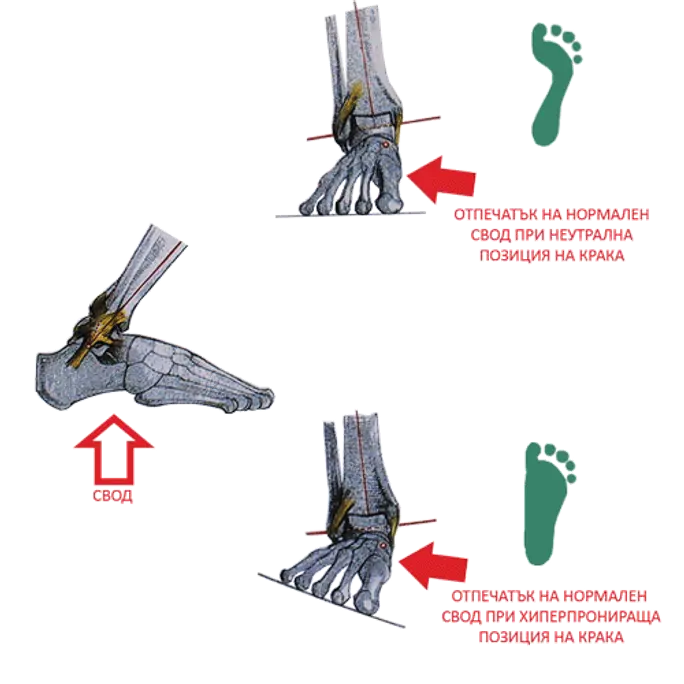 плоскостъпие или пронация