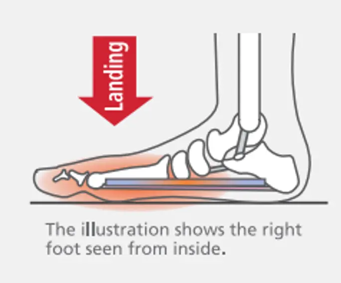 Плантарен фасцит 